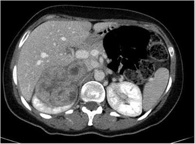 Case Report: Successful R0 resection in locally advanced retroperitoneal sarcomas